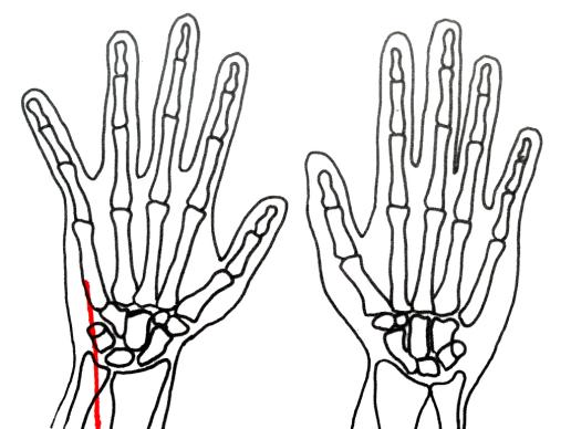 Spier(strek)pees: Klacht strekpees pinkzijde pols | Fysiotransparant